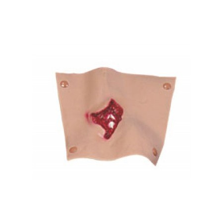 Fractura compuesta Humerus moulage sangrado por Simulaids.