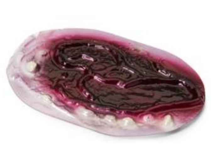 Quemaduras (1º, 2º y 3º grado)