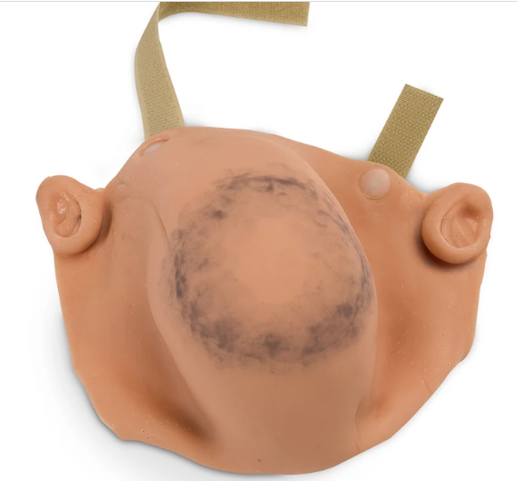 Hemorragia subgaleal